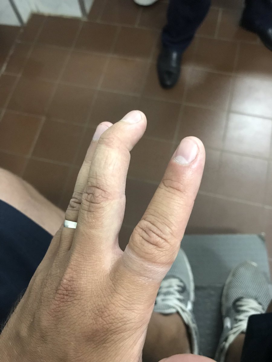 NahuelVentura9's tweet image. Te queres hacer el Lebron James jugando al basquet, pero sos Nahuel 🤦🏼‍♂️🏀 #Lesion #TendonRoto #Ferula #8Semanas