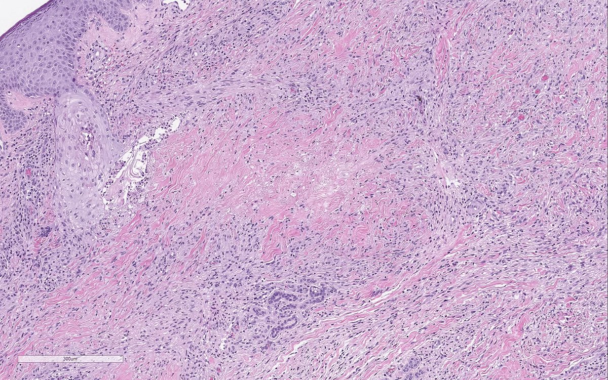 necrobiosis lipoidica diabeticorum pathology