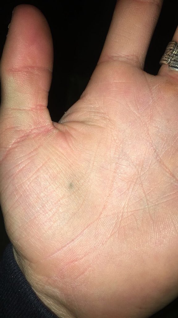 MattGarvey1's tweet photo. @Los_Writer Got this stabbing an apple in grade 6 https://t.co/g0sGE7WpMT