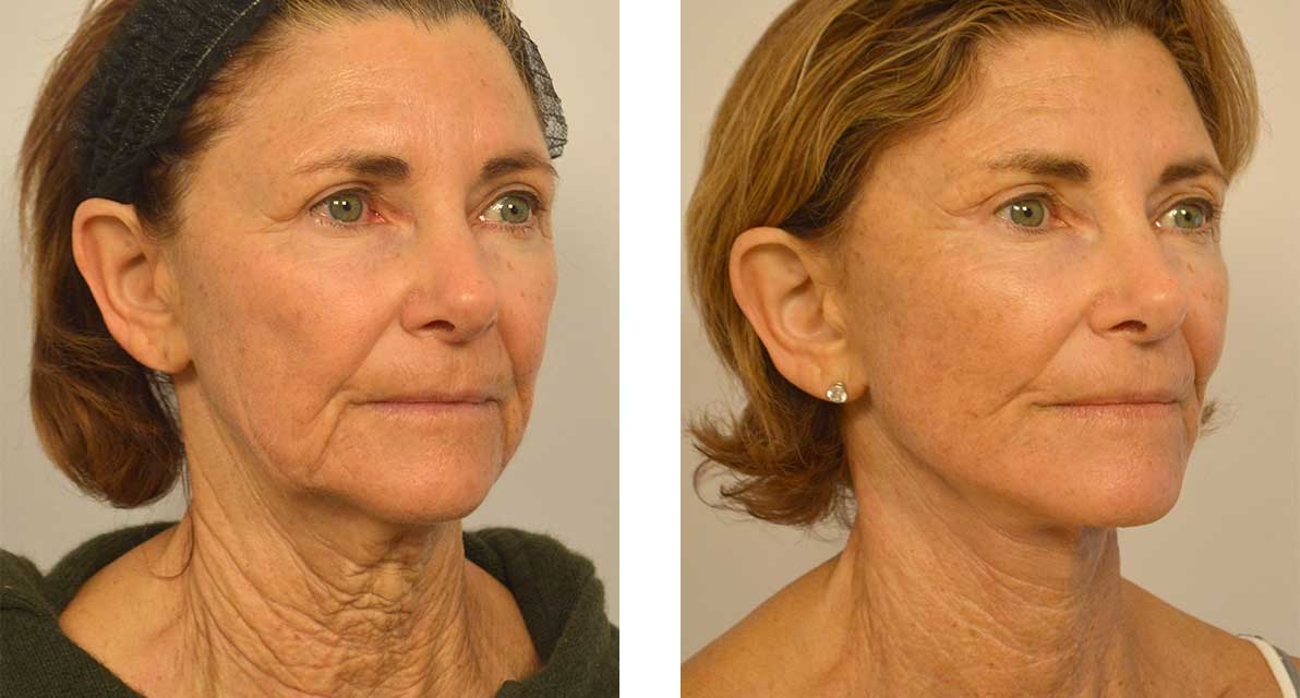 TebMedTourism's tweet photo. @TebMedTourism company aestheticians are experienced and qualified to perform your aesthetic procedure.
Compare Face-lift prices in Iran here:https://t.co/ACOJz4QzWG
#FaceLiftInIran #thread_lift_in_iran #Rhytidectomy_in_iran #Rhytidectomy #face_lift #thread_lift https://t.co/afVoBkRD6V