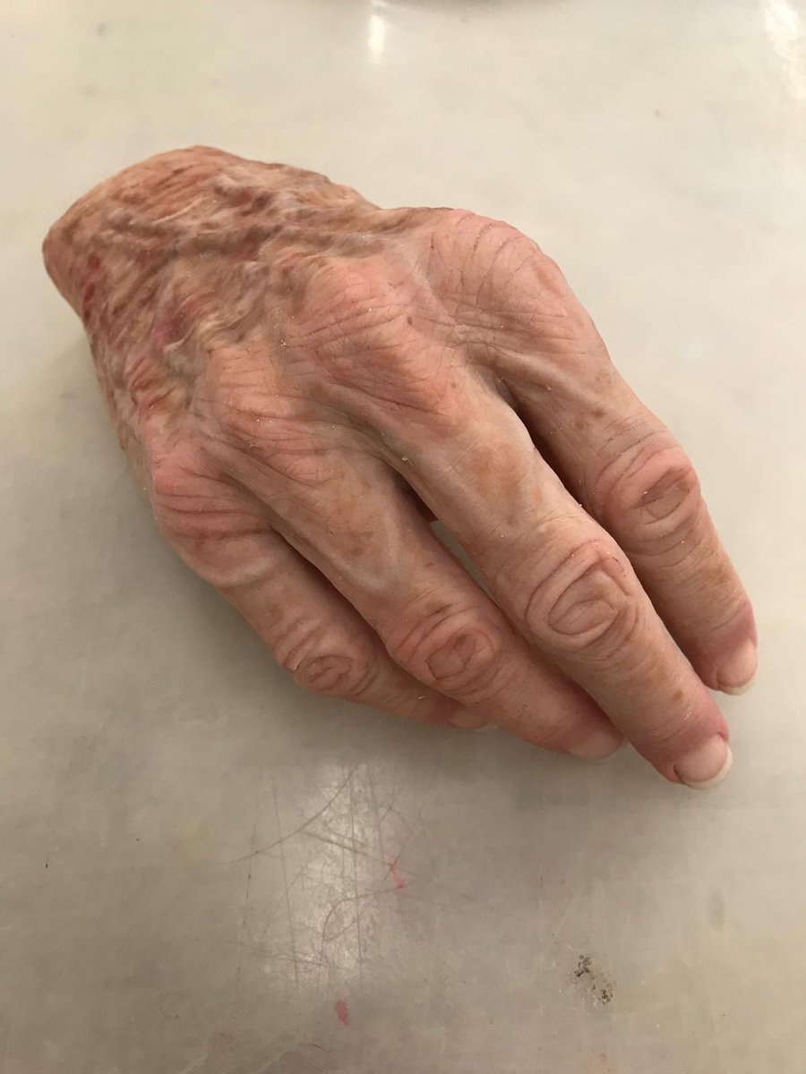 Our bespoke silicone cosmeses can be tailored to suit whatever your requirements. Just look at the level of detail on this elderly patient’s hand. We are extremely proud of our talented technicians. #StriveForBetter