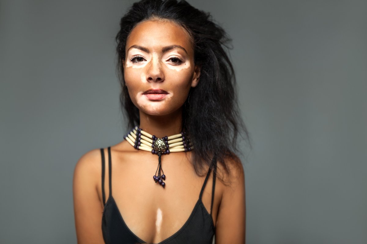 ClinuvelNews's tweet photo. #CLINUVEL recently announced Phase II study results in vitiligo. #Vitiligo affects 0.5–2% of the world’s population, an estimated 45 million people. Learn more: https://t.co/ehKG6T3rQX

#Pharma
#Biotech
#Dermatology https://t.co/C1lGrmz44O