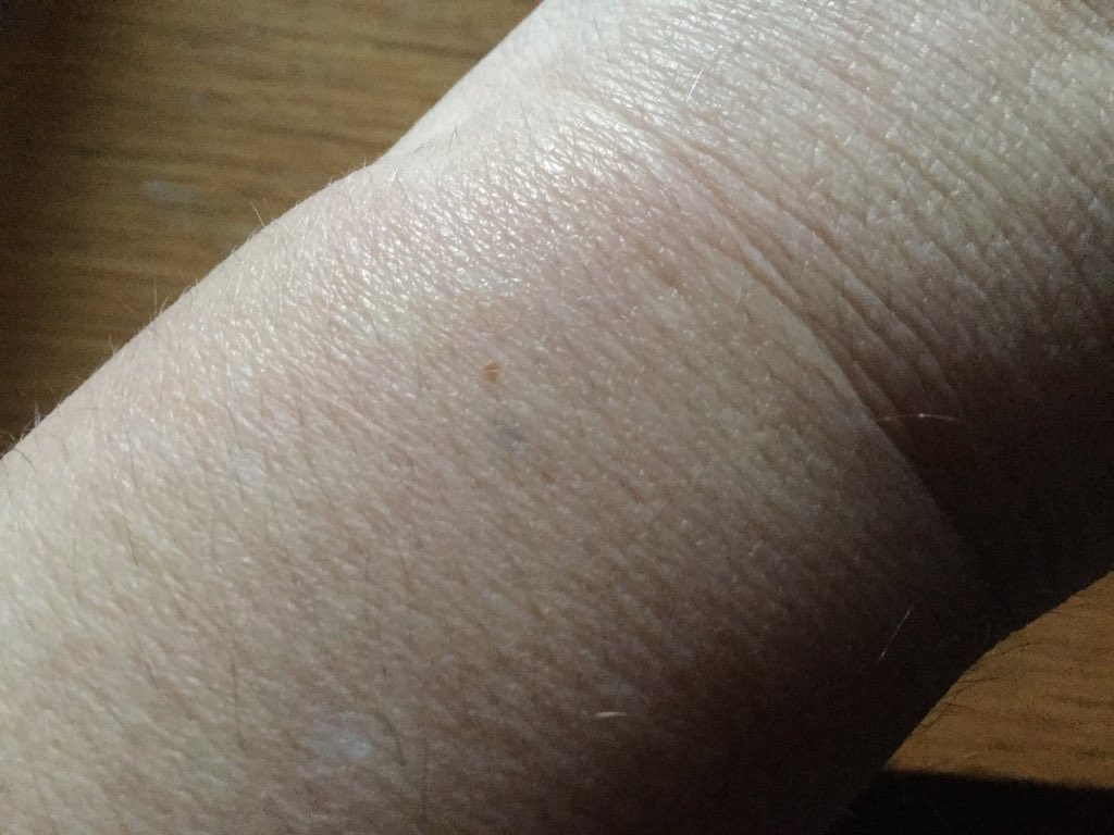 jude_gurd's tweet photo. @Los_Writer My left wrist...thanks to Nicola French 40 years ago https://t.co/6zBQip81mB