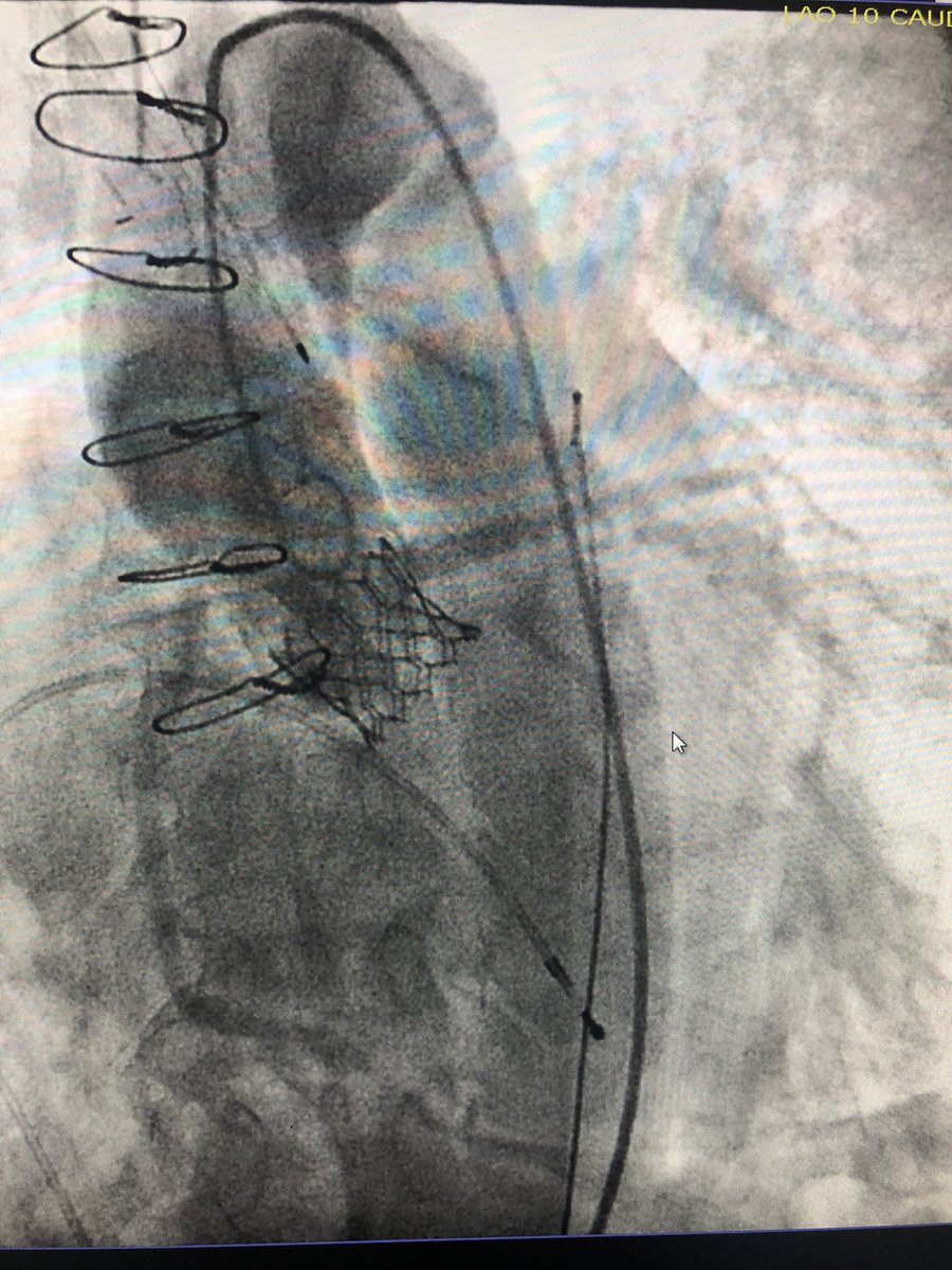 KaliyadanMD's tweet image. #TAVR #doubleprotection 56 yo f w/ SAVR 23 mm Freestyle. No CAD, ESRD. Severe prosthetic AS for ViV TAVR. Low RCA height at 6.8 mm and LCA at 8.1 mm. 23mm S3 deployed after protection of both coronaries. Post angio compromise of both cors. LM/RCA stents deployed w/ good result.