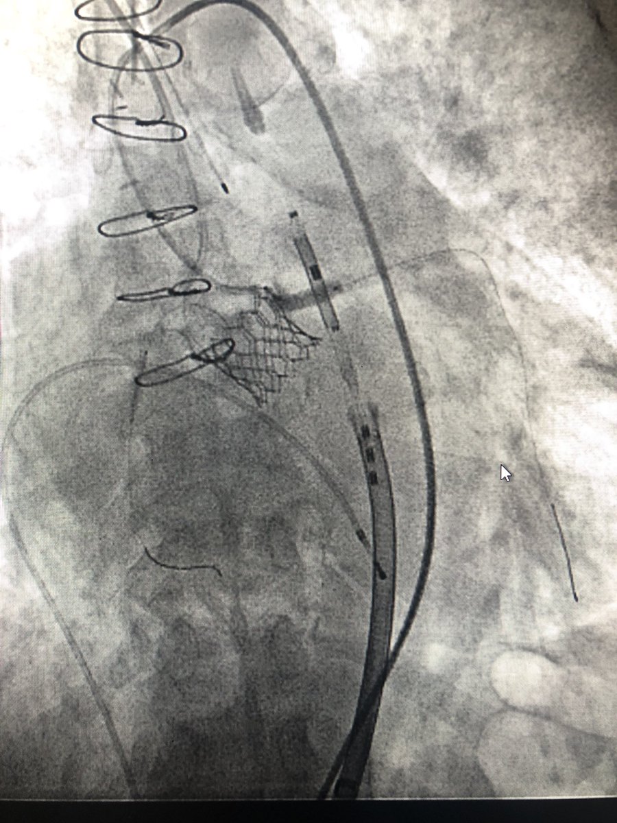 KaliyadanMD's tweet image. #TAVR #doubleprotection 56 yo f w/ SAVR 23 mm Freestyle. No CAD, ESRD. Severe prosthetic AS for ViV TAVR. Low RCA height at 6.8 mm and LCA at 8.1 mm. 23mm S3 deployed after protection of both coronaries. Post angio compromise of both cors. LM/RCA stents deployed w/ good result.
