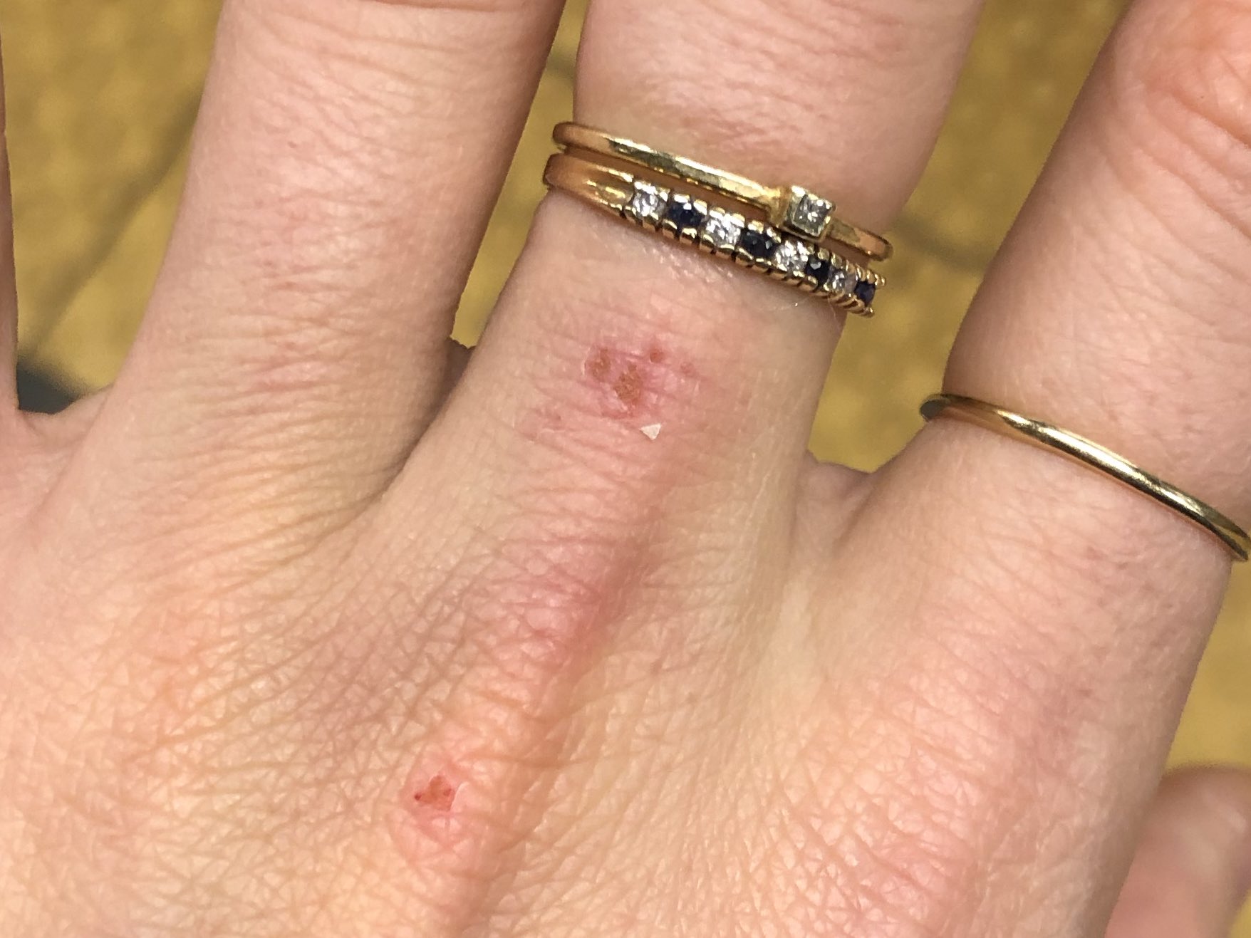 Sophie Vershbow on X: "Even thought I've been in recovery for years, the  triggers of bulimia never fully disappear. I still wince anytime I scratch  a knuckle, thinking about how hard I