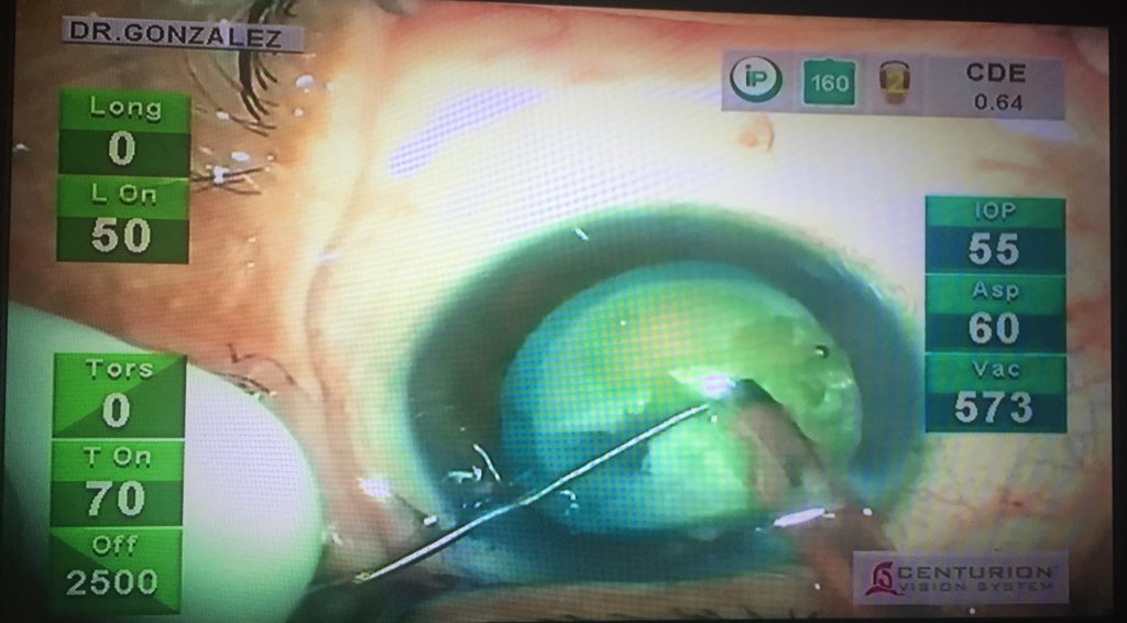 dr_robertogs's tweet photo. High-vacuum setting on phacoemulsification surgery #phacoemulsification #cataractsurgery #IOL #pseudoexfoliation #high-vacuum #cataract #OR #ophthalmology #anteriorsegment #activefluidics #torsional https://t.co/j5vVrRu7Yc