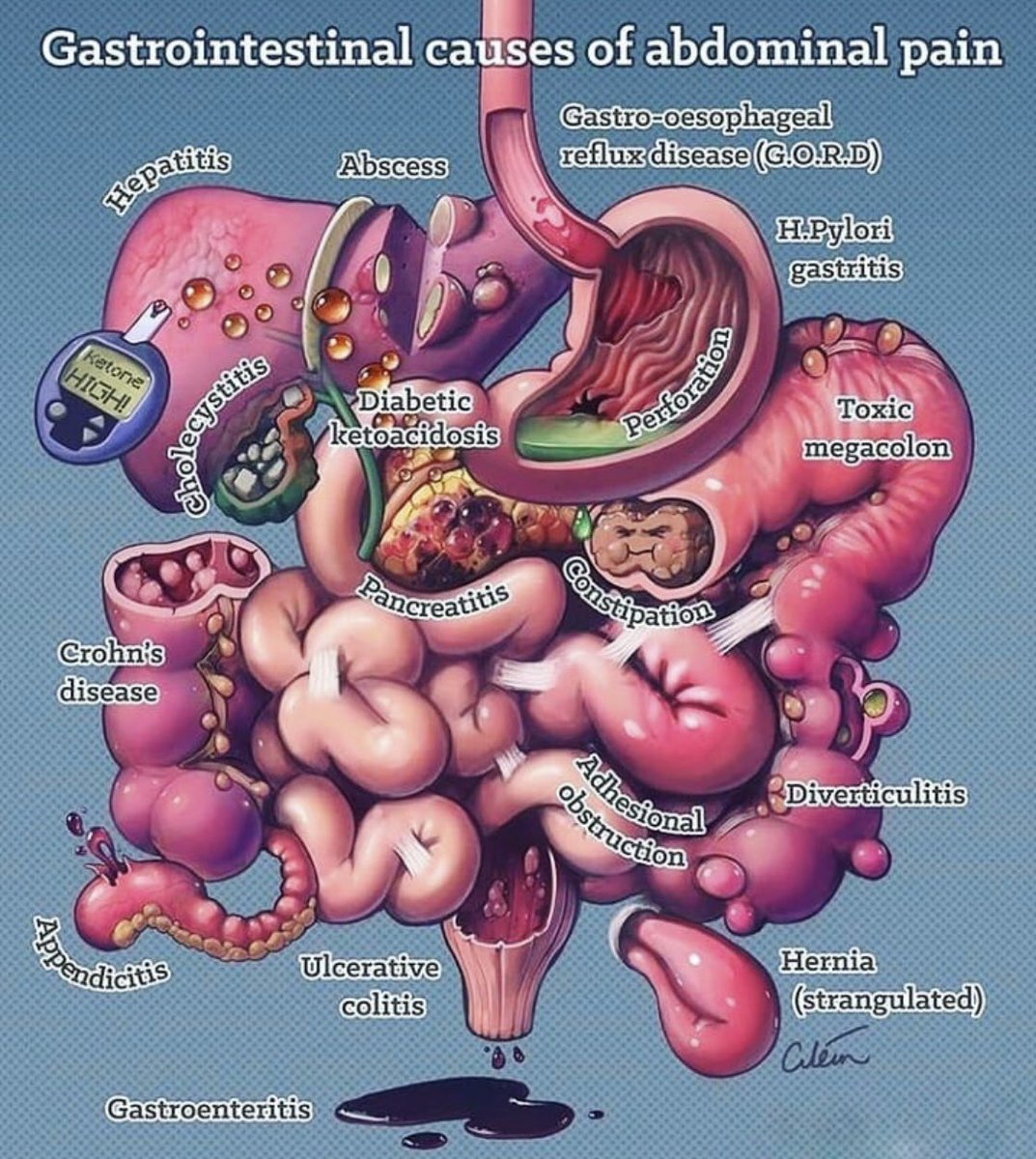 Nabeelosis's tweet image. GI causes of abdominal pain 👌🏻