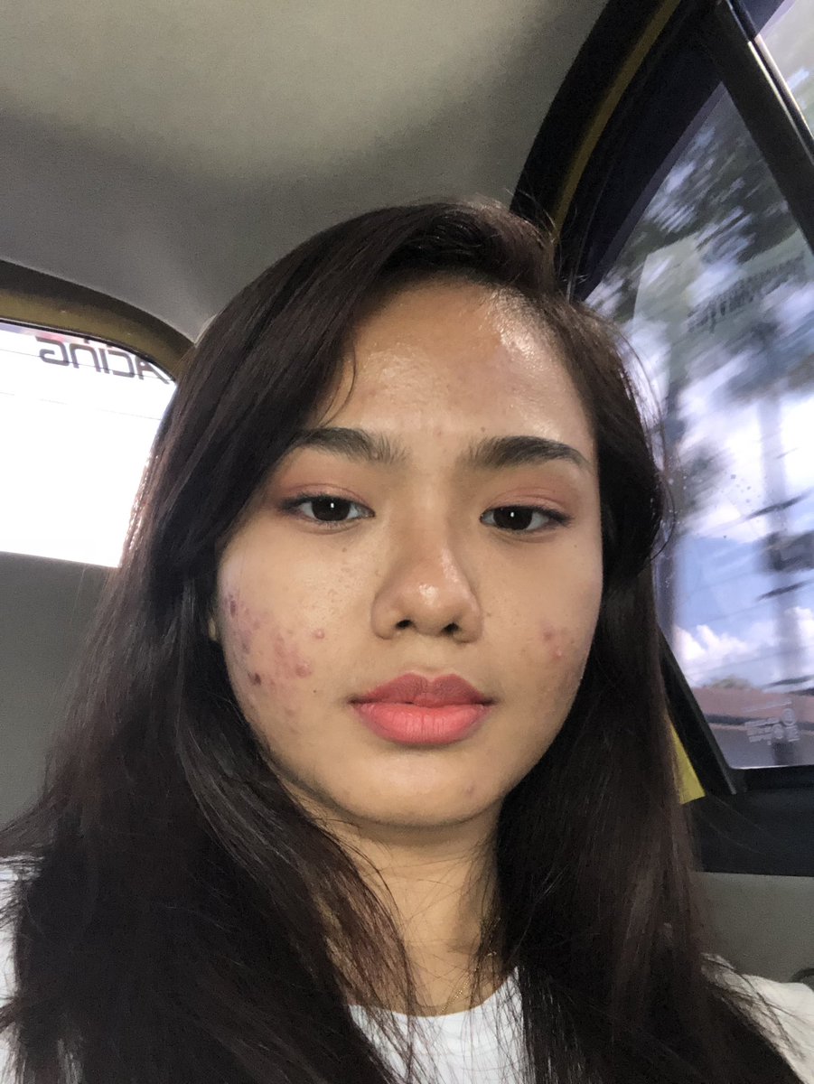 nasyahasla's tweet photo. acne cannot contain the beauty that is me :) jk im weeping as we speak :) https://t.co/jMGal9DRta