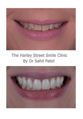 HarleyStSmile's tweet photo. #DrSahilPatel #CosmeticDentist #london #Smile #SmileMakeover #Confidence #NewSmile #LondonSmiles #London #HarleyStSmile #HarleyStreet #killersmile #HappyClient #freeconsultation #smilesimulation #Freewhitening https://t.co/tKRloFhrZi