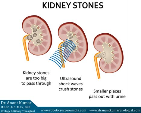 Lithotripsy is a procedure that uses shock waves to break up stones in the kidney, bladder, or ureter. After the procedure, the tiny pieces of stones pass out of your body in your urine.
#kidneystones #kidney #Dranantkumar #Delhi #Lithotripsy #Urologist