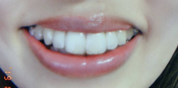 洋菓子 前歯がでかくて嫌だ 矯正しても前歯のイメージはなくならない気がする 鬱 出っ歯 の名残で上唇を上にあげて笑う癖があるので 上唇は動かさず 口角を上げて笑う癖がつくよう練習中 でもそれ意識すると愛想笑いみたいになるの なんとか自然に