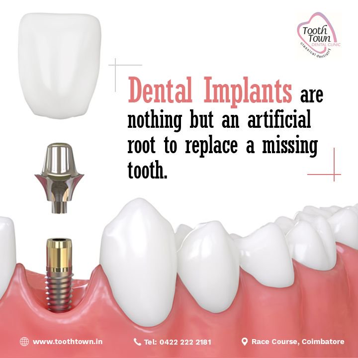 Tooth Town Dental Clinic on Twitter "DentalImplants Dental Implants