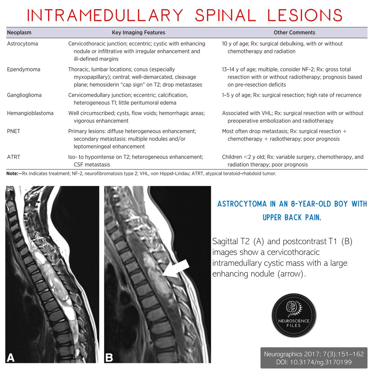 neurofiles1's tweet photo. #PediatricThursday #Neurosugery #Pediatrics #SpinalNeoplasms
Imaging Spectrum of Pediatric Spinal Neoplasms π¦΄πΆπ»
ππ» https://t.co/H4RWg9fMCG https://t.co/I3WW7FxDyC