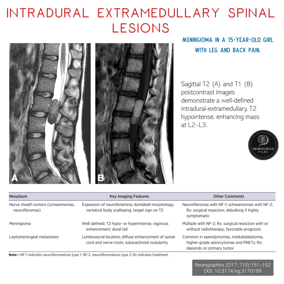 neurofiles1's tweet photo. #PediatricThursday #Neurosugery #Pediatrics #SpinalNeoplasms
Imaging Spectrum of Pediatric Spinal Neoplasms π¦΄πΆπ»
ππ» https://t.co/H4RWg9fMCG https://t.co/I3WW7FxDyC