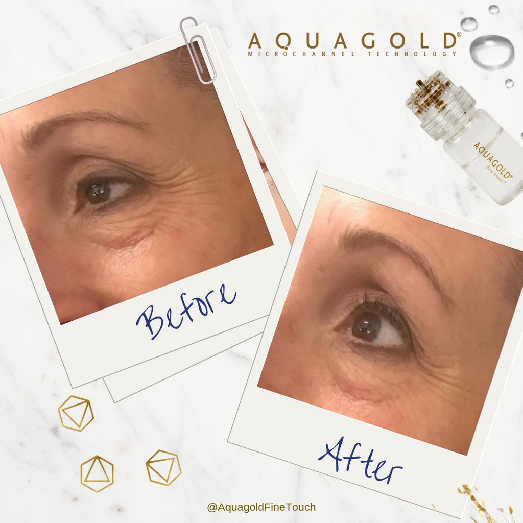 AQUAGOLD® fine touch™ allows you to effectively target skin concerns on even the most delicate areas and sensitive skin with little to no pain and little to no downtime.⠀
⠀
*Sold only to licensed professionals.
#aquagoldfinetouch #microchanneling #medicaldevice