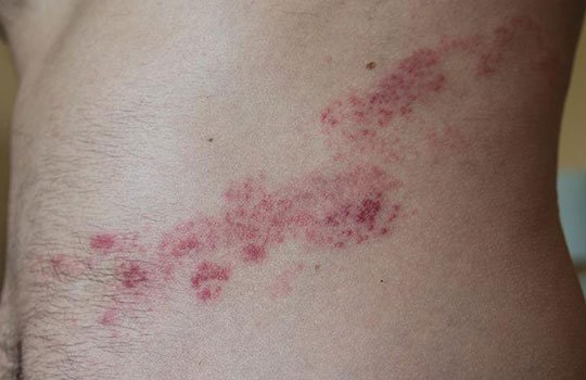 In herpes der scheide zoster Herpes genitalis