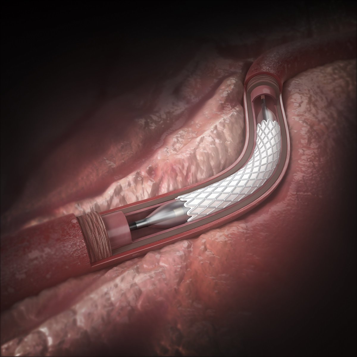 катетер стент мочеточниковый. стент урологический мочеточниковый. камень в мочеточнике уретероскопия. удаление стента у женщин. катетеризация и стентирование мочеточника.