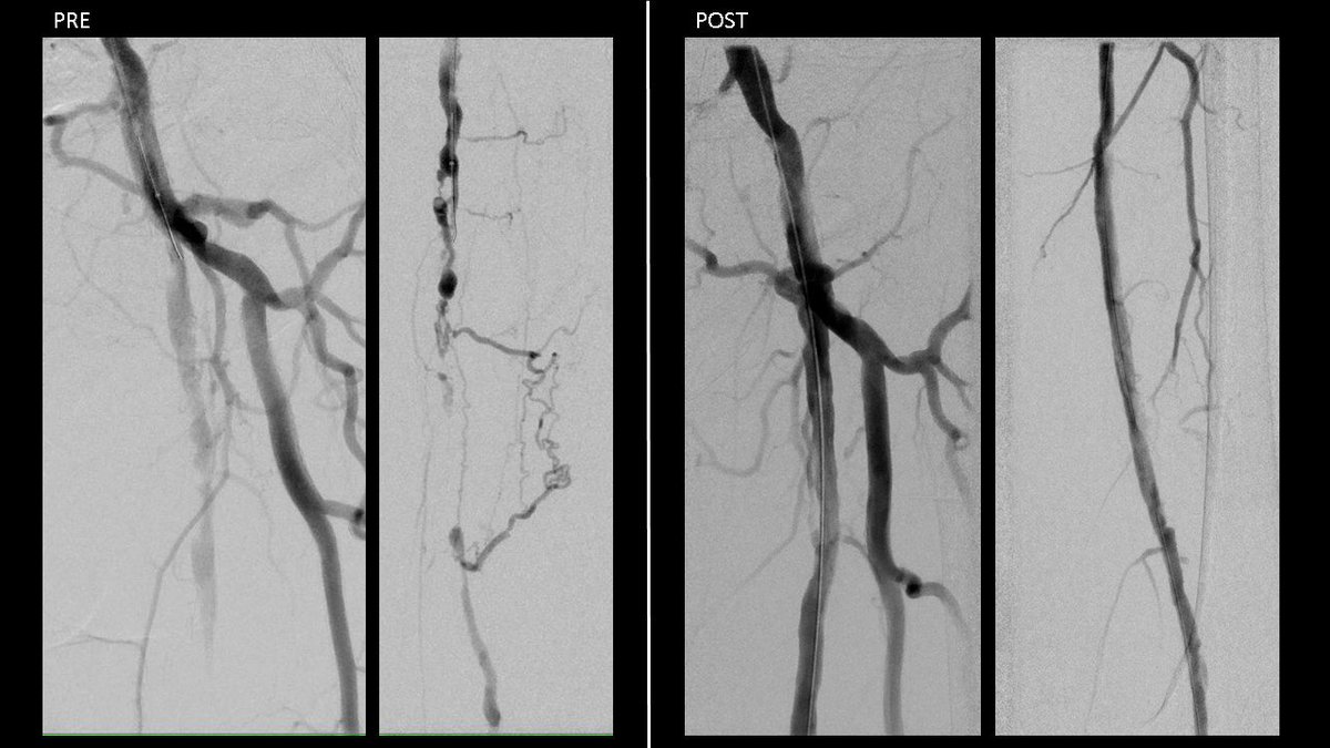 Nice IVL case with @JoeCampbellMD and Chris Bajzer. 69y M R3C with Ca+ ostial/prox SFA disease and SFA CTO. AWE->STAR through CTO then 6.0 IVL dist; 6.5 mm prox. Nice for use near CFA where we want to dec risk of dissection/need for stent. #CardioTwitter