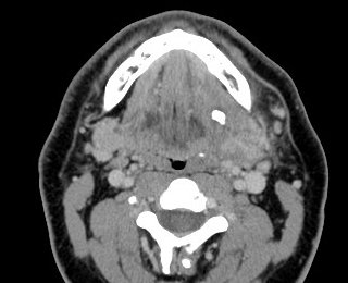 JennyKHoang's tweet image. Pain in L face. What's the cause for pain? Name for the anatomic structure involved (eponym)?

ANSWER: bit.ly/2QENK6c