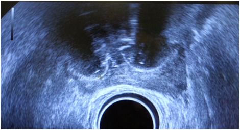 Early-Medium-Term Outcomes of Primary Focal Cryotherapy to Treat Nonmetastatic Clinically Significant #ProstateCancer from a Prospective Multicentre Registry  buff.ly/2QCAcbu
