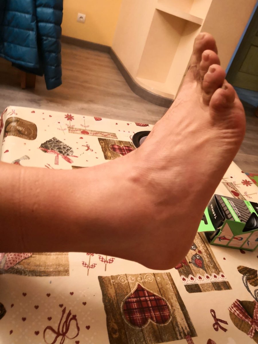 Tractortrail's tweet photo. @20run17 @trailjulian @ismacercedilla @kaikuland @jcdfotograf @Todovertical Pues parece que un #esguince a tenor de la pelotilla que tengo ahora mismo a ver qué me dice @fisiocerceda https://t.co/Obt2oTpkrd