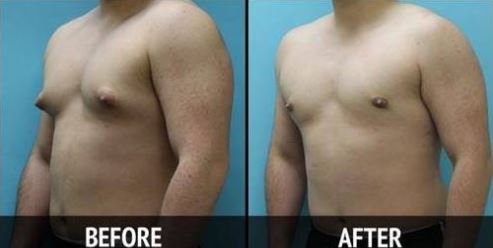SculptIndia's tweet photo. Are you fed up with #largebreastsize and want to get rid of this then #GynecomastiaSurgery is the best option for you. Through this surgery you can minimise your #breast size. Book your appointment at @Sculptclinic in delhi.

For more info visit:- https://t.co/NHICGMGR6r https://t.co/ndKg8wdw41