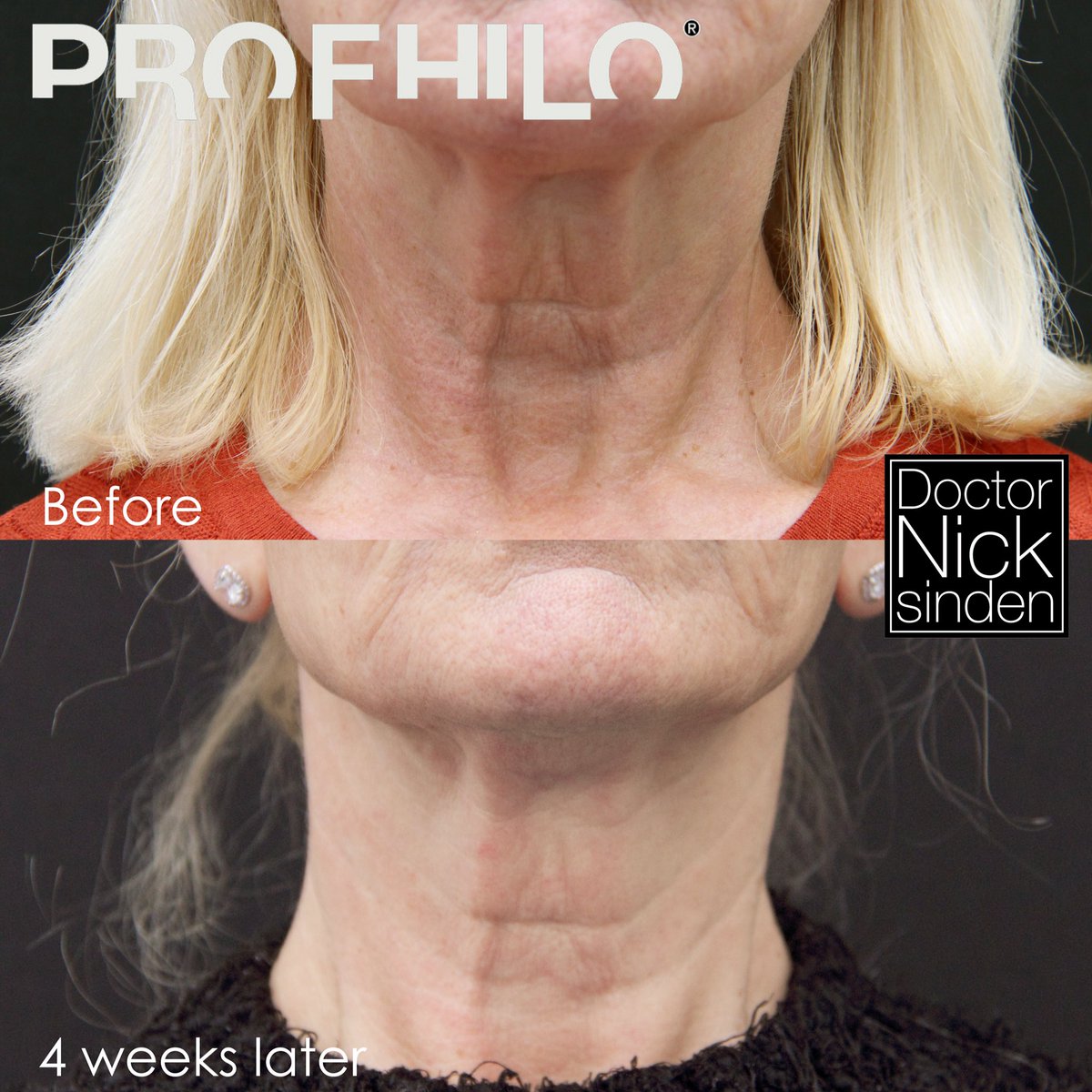 drnicksinden's tweet photo. ⭐️#Amazing results from  @profhilo_uk , and it’s only halfway through the #treatment!⭐️
We can’t wait to see her final #results in four weeks time.
#aestheticsdoctor #leedsbeauty #weekendvibes #profhilo #facialfillers #antiaging #antiwrinkle #lookyounger #lookfab #rejuvenation https://t.co/SyjQsK6ctk