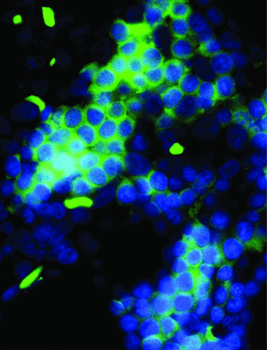 This cover shows phospho-MLKL staining of bone marrow from a patient with refractory anemia with ringed sideroblasts bloodjournal.org/content/133/2.…