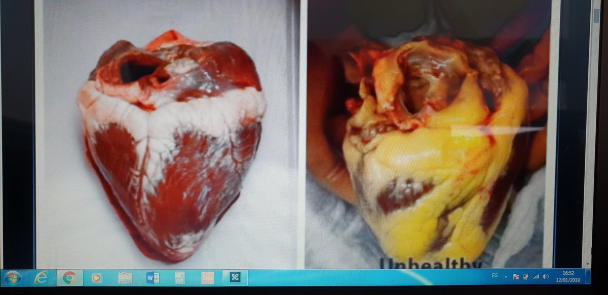 Corazón sano VS Corazón insano (cubierto de grasa visceral). Con cual te quedas? Yo lo tengo claro.
#poruncorazonsano #libredegrasa #hábitossaludables #HealthyFood
