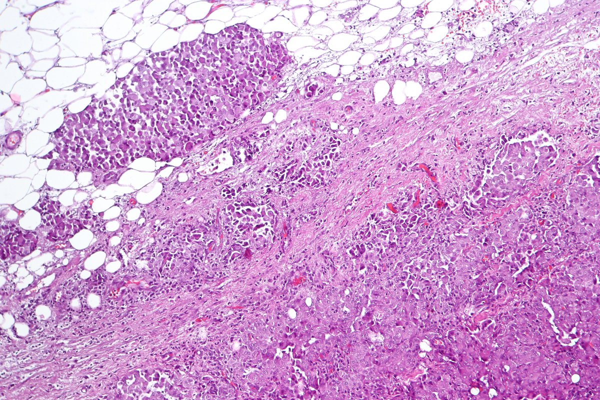 stage 3 peritoneal ovarian cancer