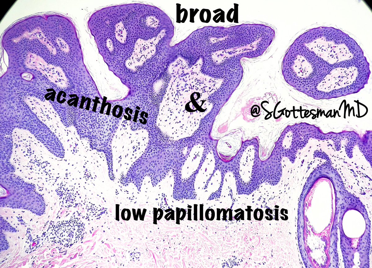 hyperkeratosis papillomatosis and acanthosis)