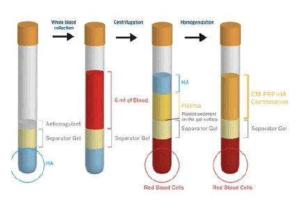 rheumatol123's tweet image. Technology rationale for the #development of #CellularMatrix® A-CP-HA Kit, certified #medical device allowing the combination of platelet rich plasma and hyaluronic acid for the #treatment of #osteoarthritis
Know more: bit.ly/2ShLXJz
#rheumatology #arthritis