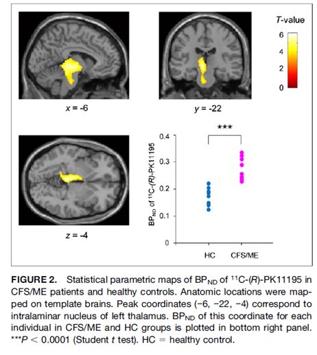 1. These studies “provide evidence of  #neuroinflammation in  #MECFS.. as well as evidence of the possible contribution of neuroinflammation to the pathophysiology of  #MECFS” #pwME http://jnm.snmjournals.org/content/55/6/945.long