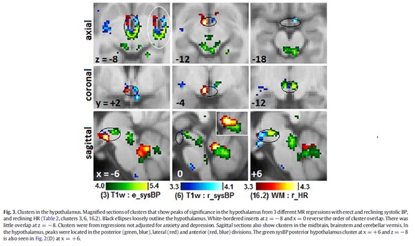 2. This Australian study found abnormalities in the  #brain MRIs and peripheral Blood Pressure and Heart Rate in  #MECFS patients including the Vasomotor centre, midbrain and hypothalamus  #pwME https://www.sciencedirect.com/science/article/pii/S2213158216300584