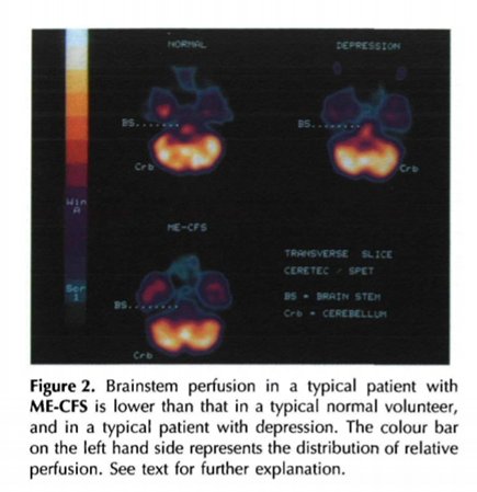 4. SPET analysis of  #CFS patients found a reduction in brain perfusion “our data suggest that brainstem hypoperfusion in  #CFS patients could be due to an organic abnormality” #MECFS  #pwME https://academic.oup.com/qjmed/article-abstract/88/11/767/1569403#.XEkeFLn1j5U.twitter