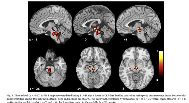 5. These MRI studies found that the “impaired brainstem signal conduction [in  #CFS patients] may stimulate elevated sensorimotor myelination.. [that may] have broad consequences for regulation of cerebral function..” #MECFS  #pwME https://www.sciencedirect.com/science/article/pii/S2213158218302237