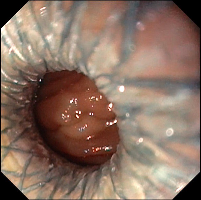 Gastroenteroanastomosis guiada por ecoendoscopia con dispositivo Hot AXIOS. Una alternativa a la cirugía para pacientes con obstrucción duodenal neoplásica no subsidiarios de protesis duodenal. #Endoscopia terapéutica avanzada @AgenciaCostaSol