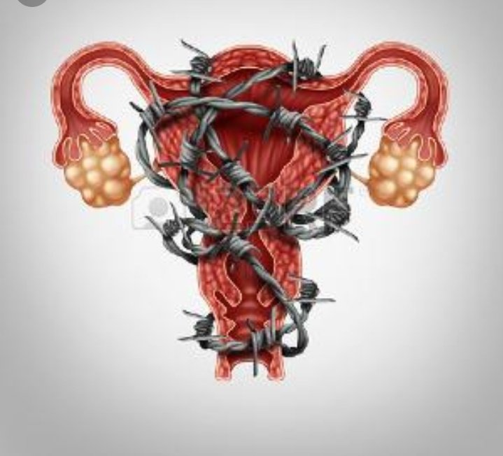 lapastorina's tweet photo. #NosSigueDoliendoLaSanidad 
#MiUteroNoEsNegocio 
@libreessure  
Los ginecólogos nos condenaron al recetarnos #Essure 
Y ahora nos abandonan a nuestra suerte y nos ignoran y humillan 
#miginememata 
80.000 mujeres implantadas en España
3000 que conocen su destino.
Y las demás? https://t.co/AgECzbSWIU