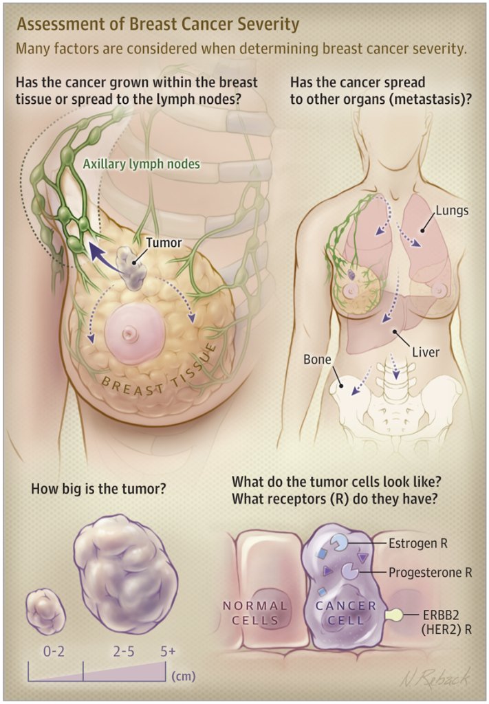 JAMA_current's tweet photo. There are 3 types of #breastcancer, distinguished by proteins expressed in the #cancer cells: Hormone receptor + (70%) has either estrogen (ER) or progesterone (PR) receptor proteins; ERBB2+ (15% - 20%); Triple-negative (15%) has none of the proteins
https://t.co/kdn6rmbbet https://t.co/NhxdxVUkpI