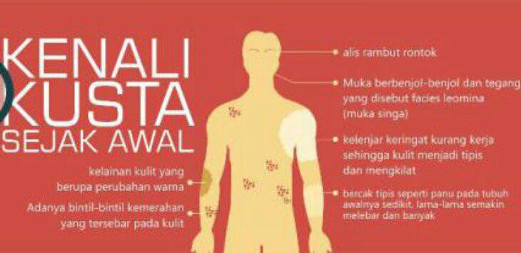 ynur864's tweet photo. Masyarakat kini sadar mau dan mampu meningkatkan pola hidup sehat. 27 Januari hari kusta, tiada lagi kusta di antara kita @MawardiFateha  @Ervinambanuu @wiwinwi23449158 @endahasucipto @pranatahumas @iprahumaspcjw1 @mamsmia  #SinergiMediaSosialASN #GakGalauLagi https://t.co/RJvVvMXErt