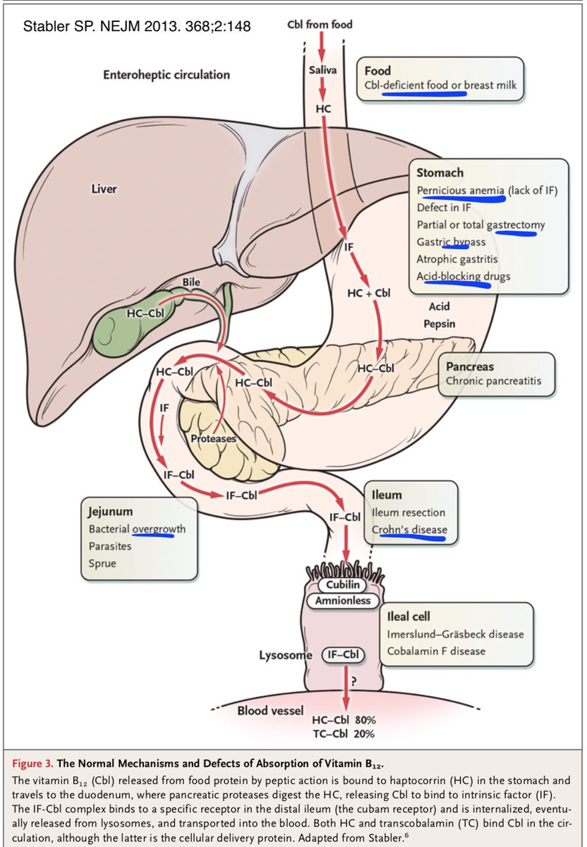 3/ I recommend D. Let’s start by looking at the causes of B12 deficiency. This great diagram shows normal absorption and outlines most possible causes. At the top is a B12-deficient diet. But the rest involve some mechanism of not absorbing.