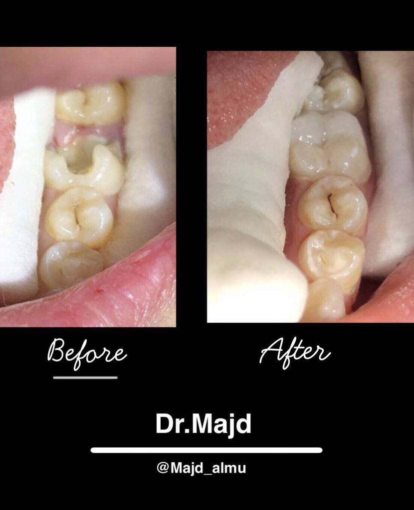 Majd_almu's tweet image. "Direct composite resin restoration 
 #directcomposite