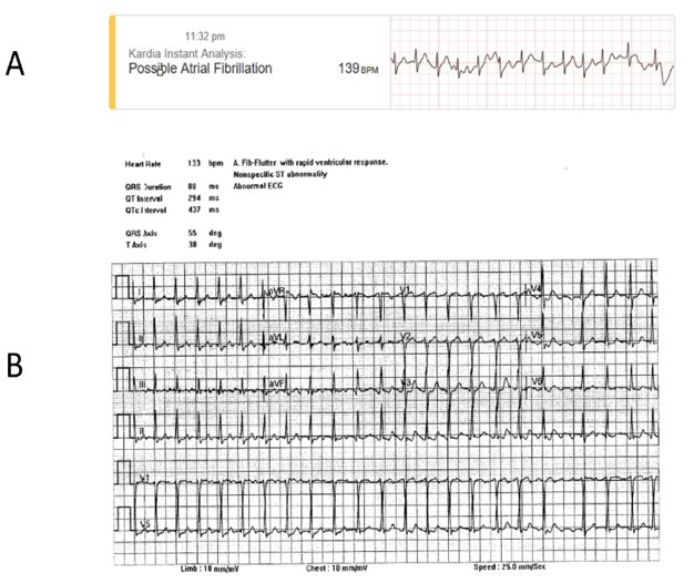 BrennanSpiegel's tweet image. Why #DigitalHealth Matters: Pt in our @CA_PrecisionMed study felt palpitations. Used @AliveCor ECG at home; diagnosed AFib (panel A). Went to ER; ECG showed AFlutter (B). Hospitalized &amp;amp; successfully treated. Images from case presented by Sandy Joung this week at WSMRF conference.