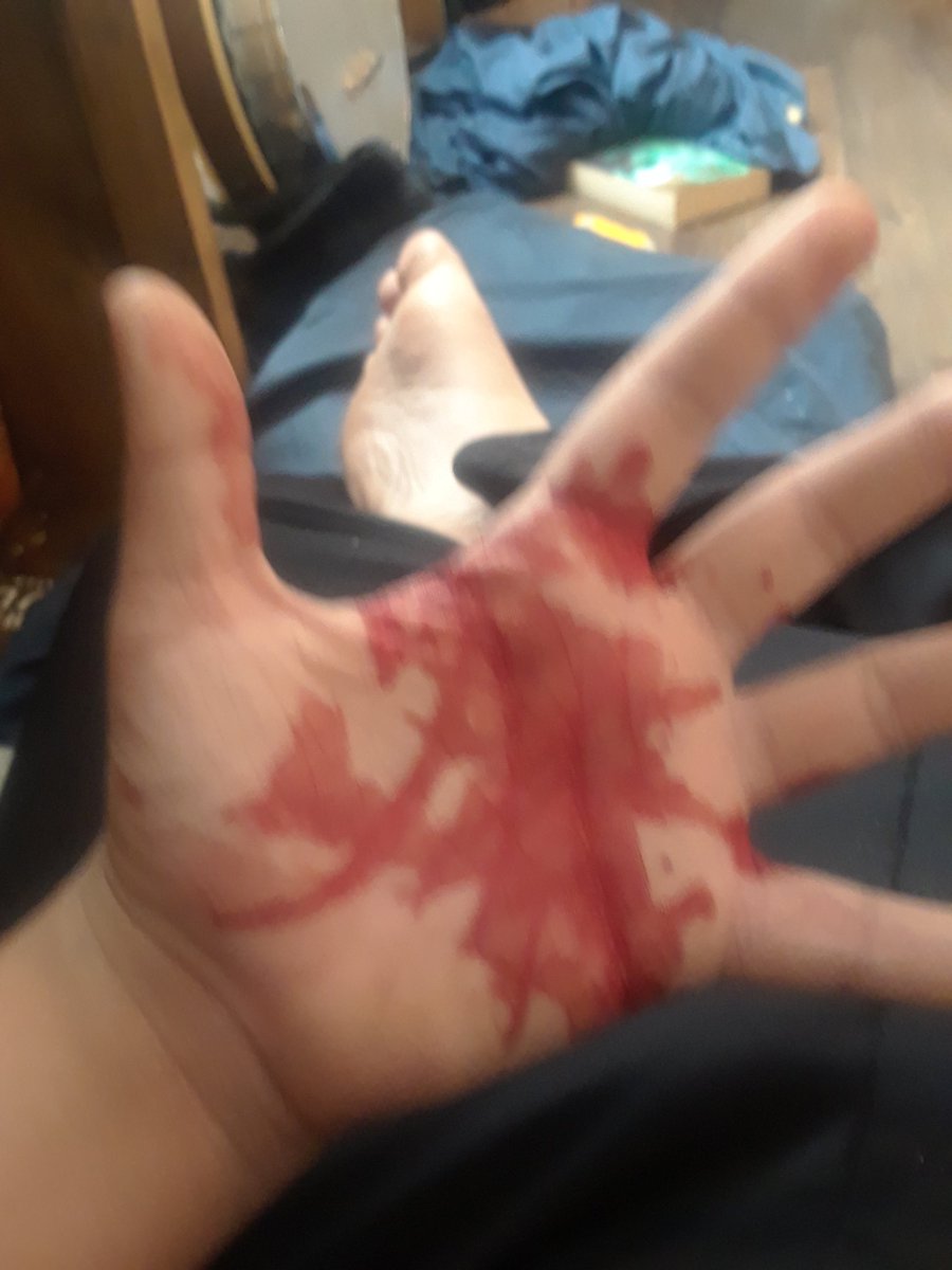RubyLegends's tweet photo. Massive nose bleed https://t.co/udq3JlezJ2