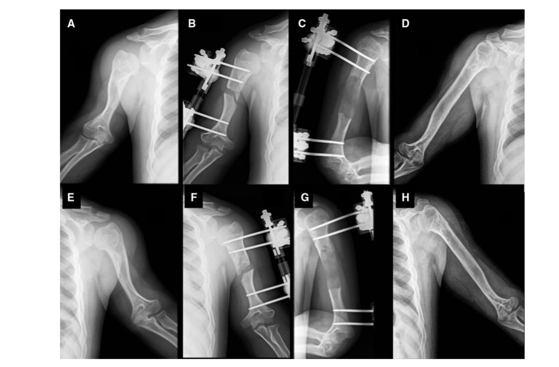 Anna Isart Torruella (@annaisart) on Twitter photo La nostra última publicació Musculoskelet Surg.: Surgical technique and outcomes for bilateral humeral lengthening for achondroplasia: 26-year experience. Ginebreda, Campillo-Recio, Cárdenas, Tapiolas, Rovira i Isart. <a href="/cirugiadecadera/">Carlomagno Cardenas</a> <a href="/PilarRovira/">Pilar Rovira</a> <a href="/DarIcatme/">DAR - ICATME</a> <a href="/QS_Dexeus/">Hospital Universitari Dexeus</a> La nostra última publicació Musculoskelet Surg.: Surgical technique and outcomes for bilateral humeral lengthening for achondroplasia: 26-year experience. Ginebreda, Campillo-Recio, Cárdenas, Tapiolas, Rovira i Isart. <a href="/cirugiadecadera/">Carlomagno Cardenas</a> <a href="/PilarRovira/">Pilar Rovira</a> <a href="/DarIcatme/">DAR - ICATME</a> <a href="/QS_Dexeus/">Hospital Universitari Dexeus</a>