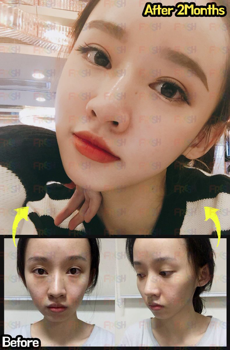 頬がこけて凹んで見える時のボリュームを出す方法 東京新宿の美容整形ならもとび美容外科クリニック