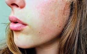 dermalicante's tweet photo. ACNÉ COSMÉTICO: ¡Peor con cada crema que uso! https://t.co/OkK3kZTjwu https://t.co/3JIPHuqhVw