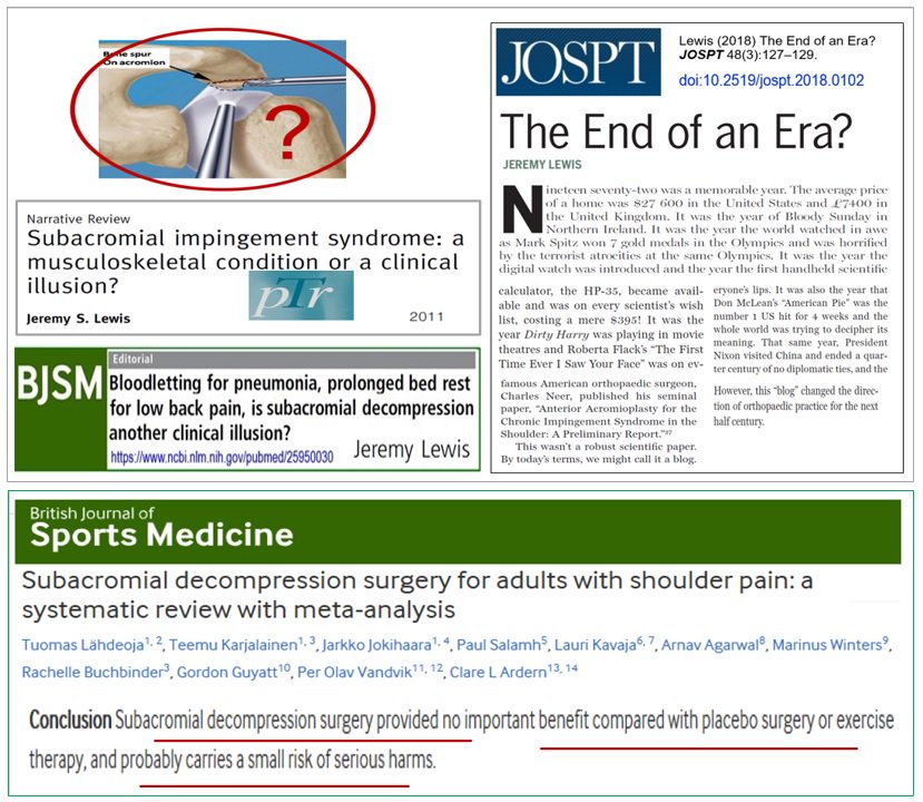 JeremyLewisPT's tweet photo. More evidence for 'An End of an Era' for subacromial decompression (SAD)?
from @BJSM_BMJ  https://t.co/SQhFPhnaPs

https://t.co/WmXXEedTlD
https://t.co/BnzfVduqBS
https://t.co/AfkQVmsyUF

ONLY consider SAD after appropriate non-surgical management #uselanguagethoughtfully https://t.co/edPGw9kXOJ