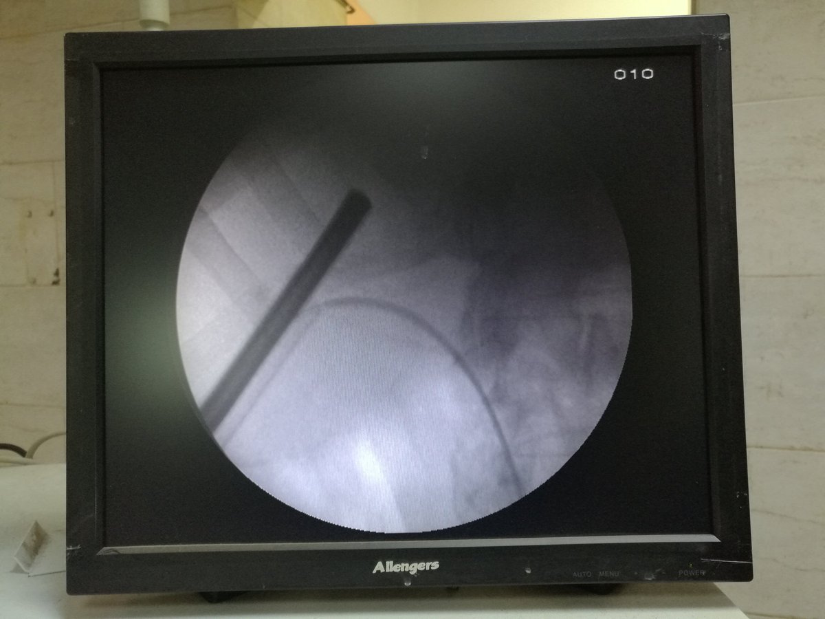 desoky_esam's tweet photo. In supine pcnl it is easy to reach the upper calyx from lower calyx https://t.co/xZWCWtQlYP